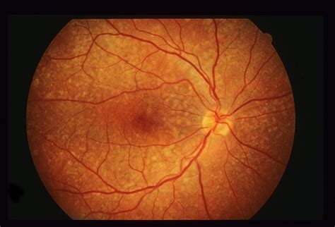 Birdshot Retinochoroidopathy 